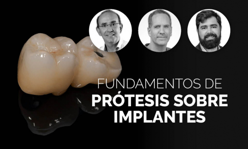 Fundamentos de prótesis sobre implantes