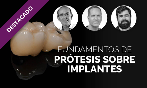 Fundamentos de prótesis sobre implantes