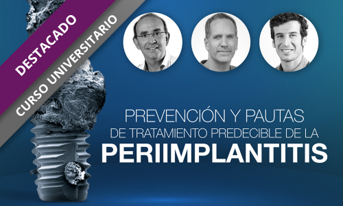 Prevención y pautas de tratamiento predecible de la periimplantitis