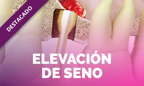 Elevación de seno – ONLINE