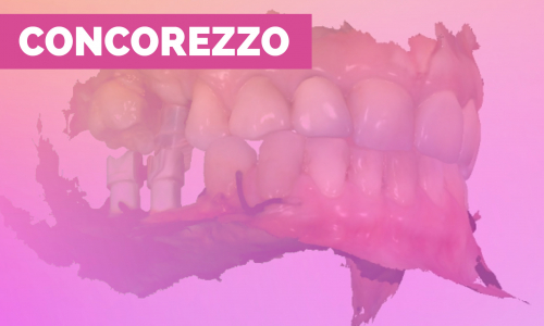 Flusso digitale con impianti corti e stretti