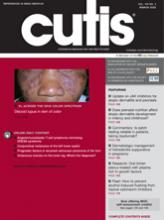 Oral Lichen Planus Treated With Plasma Rich in Growth Factors