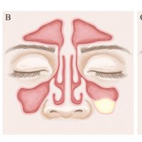 Figure 1: Differences between A- Pseudocyst, B- Mucous retention cyst and C-Mucocele.