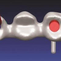 Fig. 1 Example of a prosthesis included in the study, observing angulation of the screw channel in position 24 (Group 1) and no need of angulation in position 26 (Group 2). The screw emergence is shown in red and screw emergence correction using CAD/CAM technology is shown in blue. CAD, computer-aided design; CAM, computer-aided manufacturing.